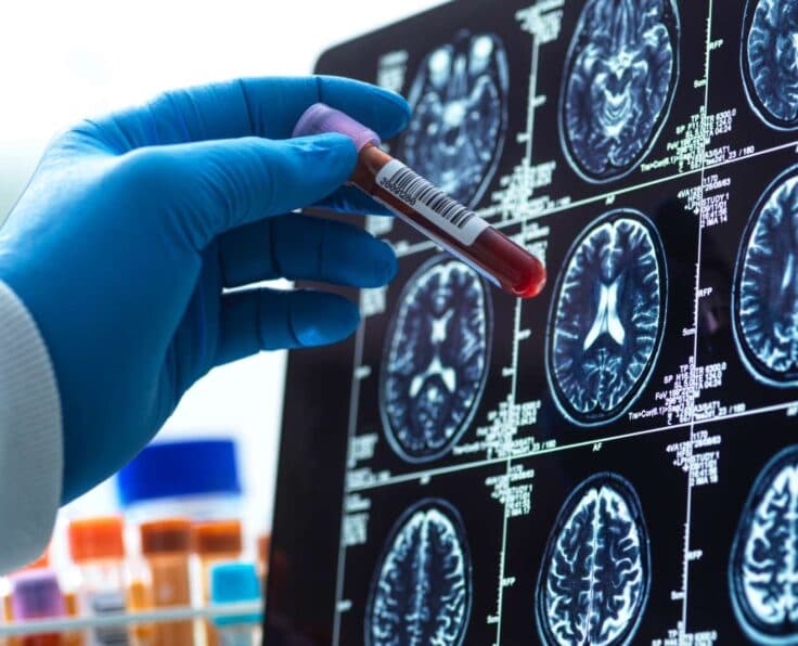 Tratamento com cannabis medicinal em Neurologia