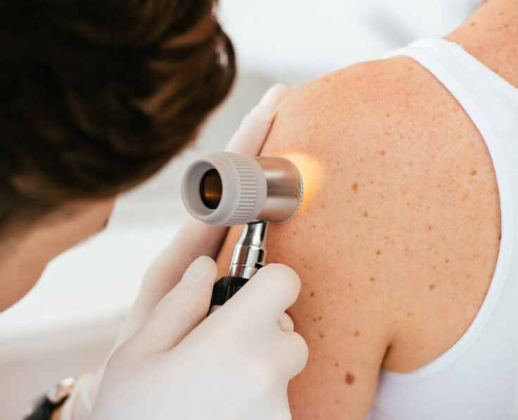 cropped view of dermatologist in latex gloves holding dermatoscope while examining patient with skin